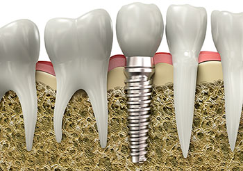 Dental Implants, Brantford Dentist